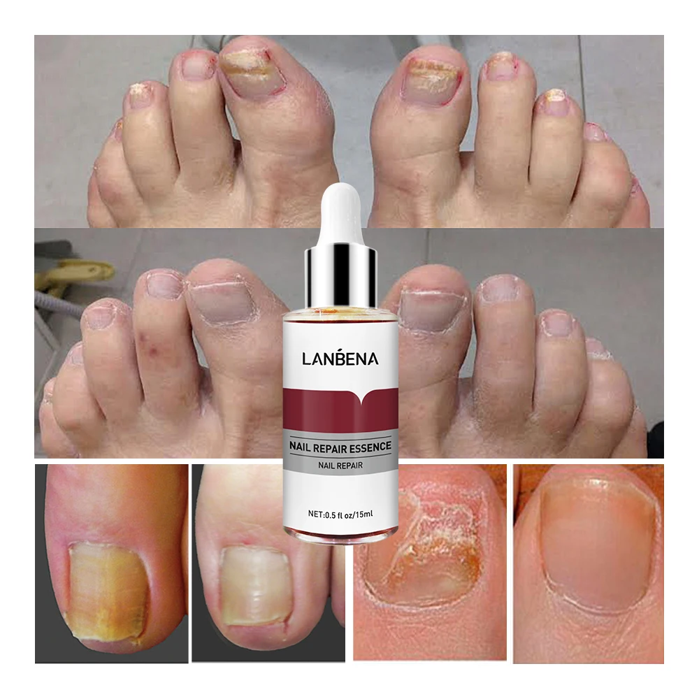 LANBENA Fungal Nail Treatment Feet Care Essence Removal Fungus Healthy Repair Serum Anti Infection Paronychia Onychomycosis
