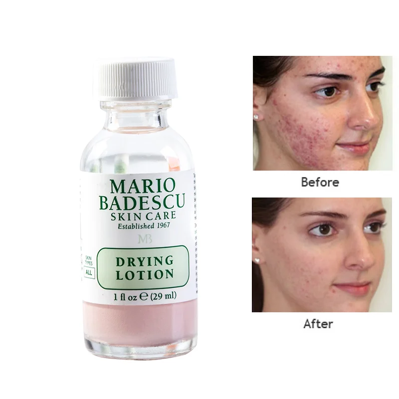 

29ml An Effective Acne Treatment Original Mario Badescu Drying Lotion Anti Acne Serum Pimple Blemish Removal Skin Care