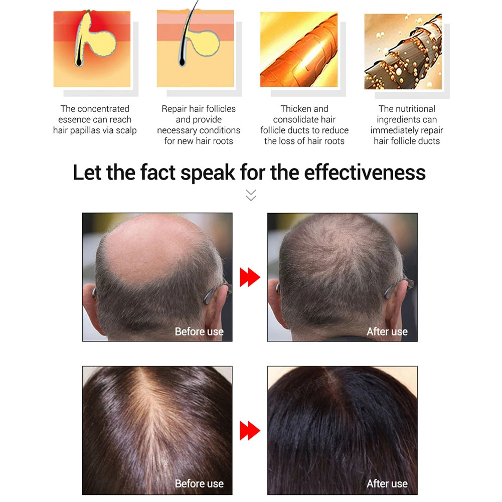 Эссенция для роста волос женьшень кожи головы густая эссенция выпадения
