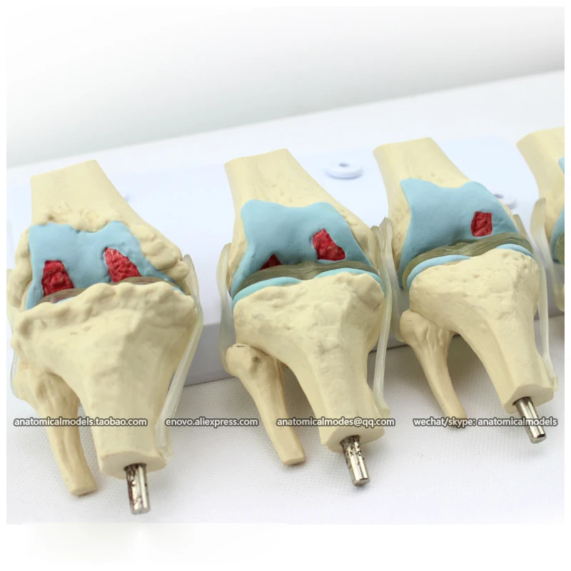 12359/человека 4-х ступенчатый остеоартрит колена комплект совместное Исследование