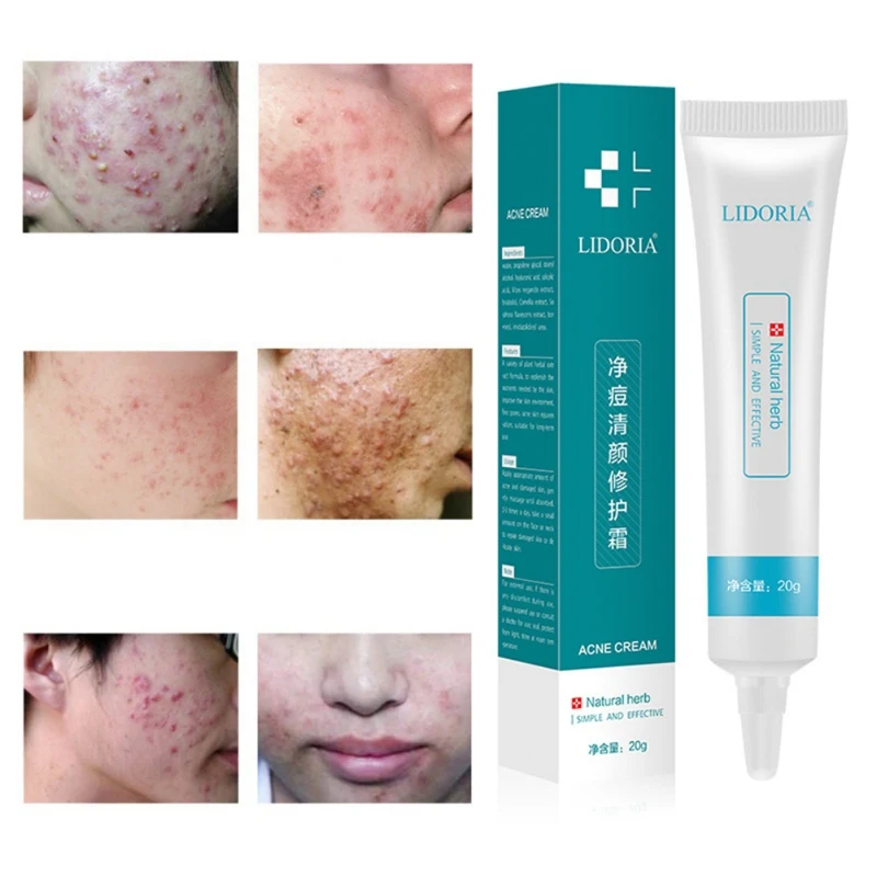 Acne Treatment Hyaluronic Acid Face Cream Acne Scar Remove Skin Care Shrink Pores Blemish Facial Spot Cream