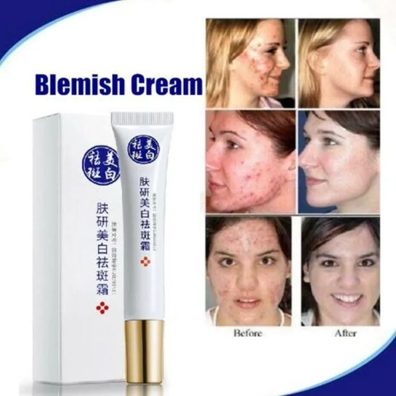 20ML Freckles Acne Pimple Scar Dark Spots Removal Face Spots Quick Cream Removal Face Whitening Use Skin Cream M5M7