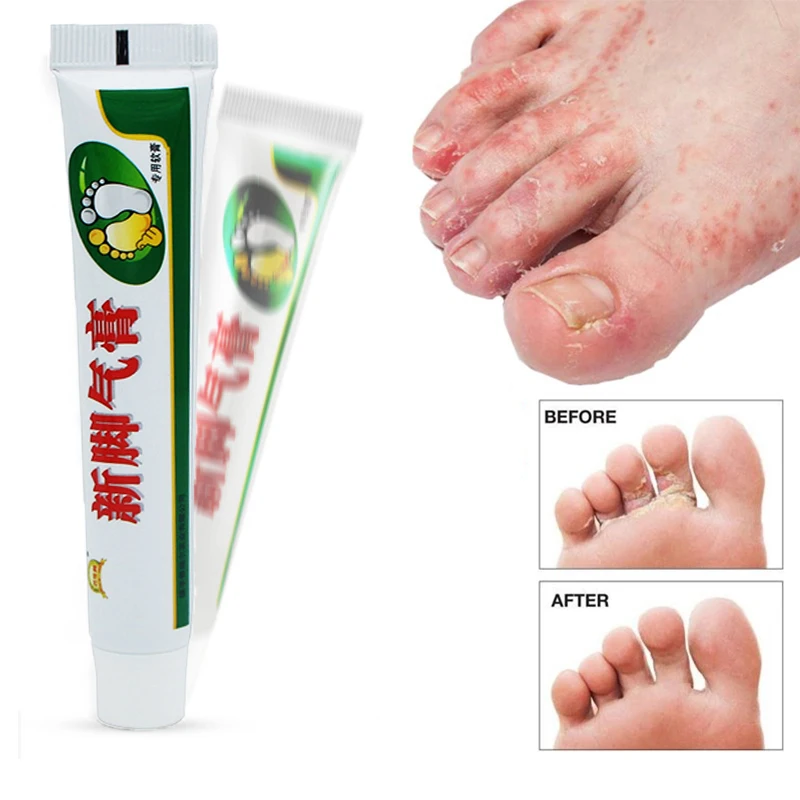 

1Pcs Athlete Foot Cream Erosive Beriberi Anti-Itch Sweat Odor Feet Psoriasis Pain Patch Antibacterial Herbal Ointment Foot Care