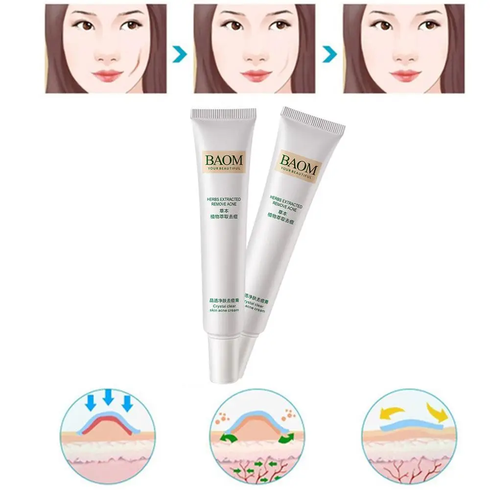 

Effective Acne Removal Cream Acne Treatment Fade Spots Moisturizing Whitening Control Oil Shrink Pores Cream Skin Care