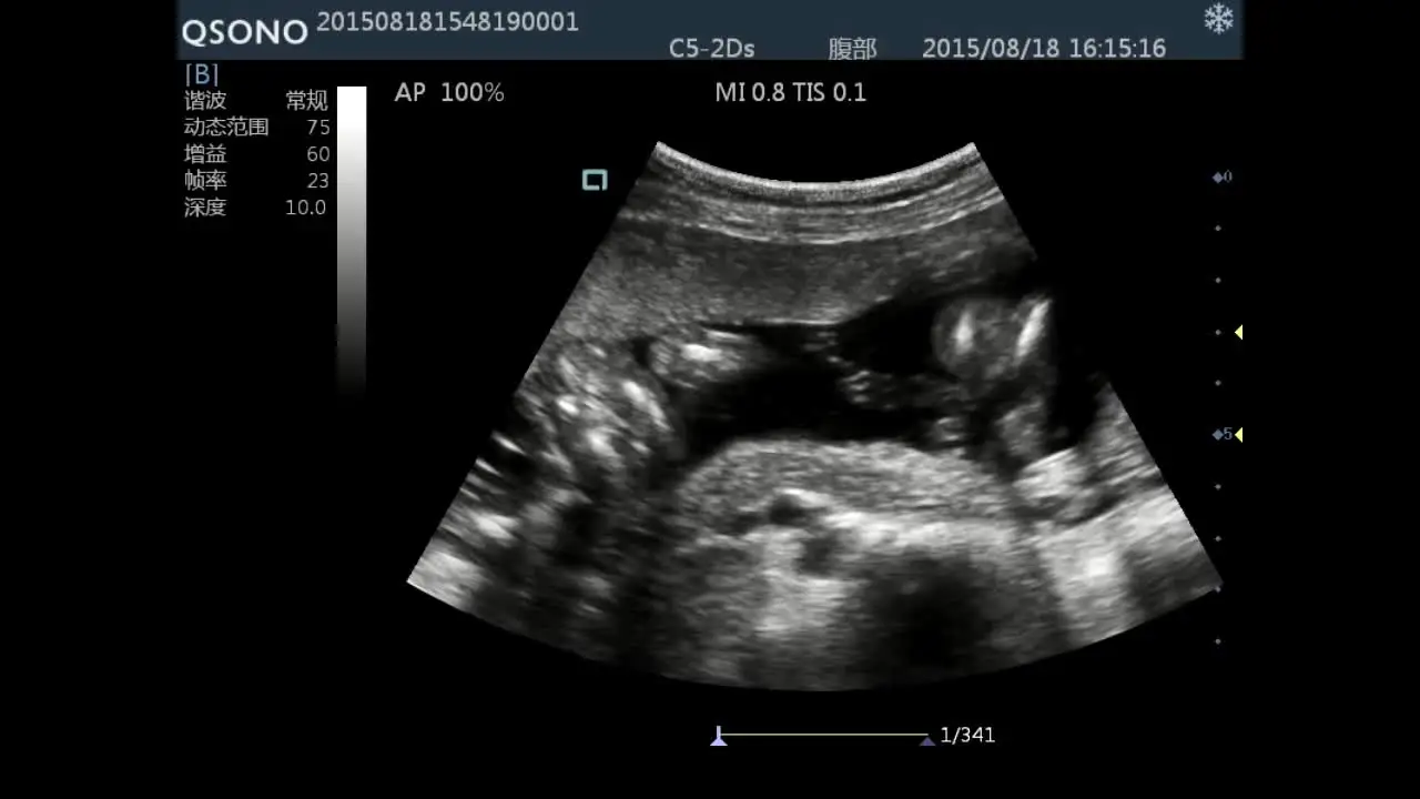 

High quality portable 3D doppler ultrasound machine best ultrasound machine