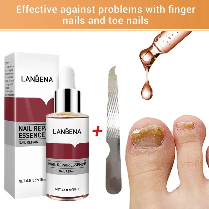 

Nail Fungal Treatment Feet Care Essence Nail Foot Whitening Toe Nail Fungus Removal Gel Anti Infection Paronychia Onychomycosis