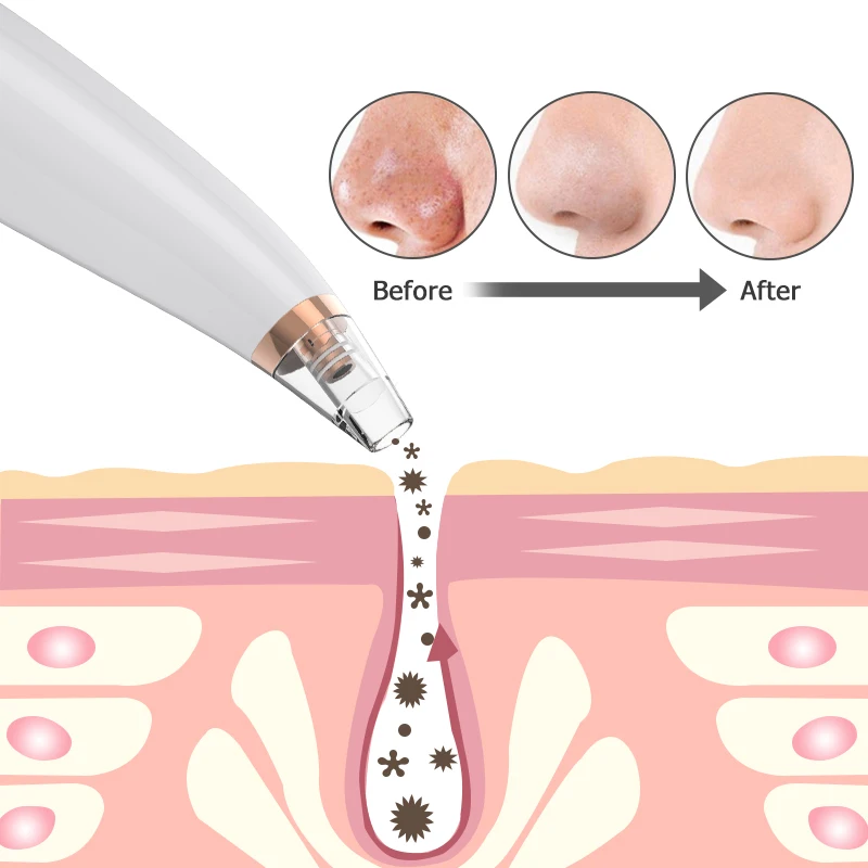 

Blackhead Remover, Facial Pore Cleaner Electric Acne Extractor Kit with 3 Suction Head