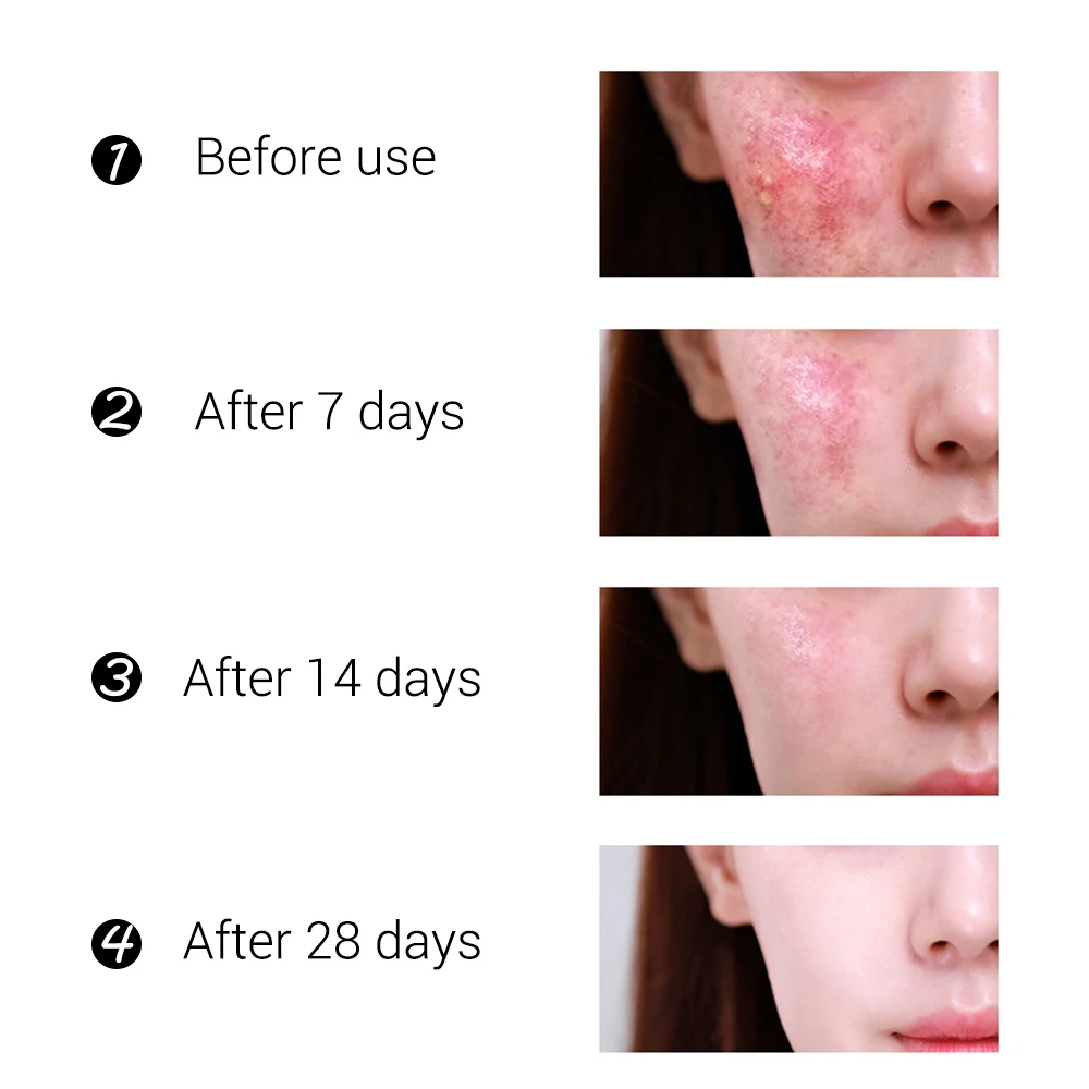 

BREYLEE Anti Acne Repair Set Facial Mask Treatment Removal Oil Control Cream Shrink Pores Moisturizing Face Skin Care Serum