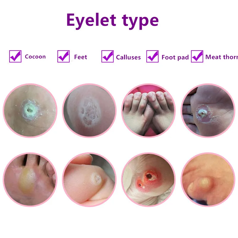 Защитные накладки для ног кукурузные мозоли подошвенные бородавки пластырь