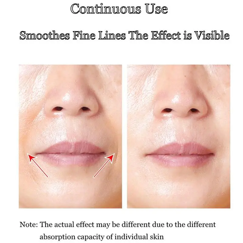 

Hyaluronic Microneedle Nasolabial Folds Antiwrinkle Removal Frown Patch Face Lines Hyaluronic Care Acid Moisturizing AntiAg U2X3