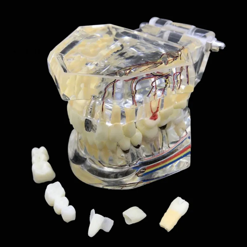 Стоматологическая реставрация зубов Модель с зубным нервом отсоединяемые зубы