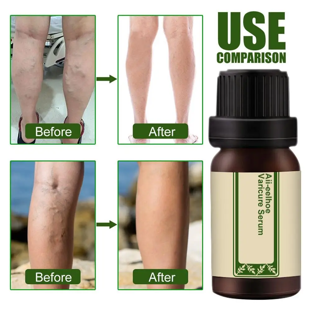 Натуральное масло для варикозного расширения вен 30 мл сыворотка ухода за ногами