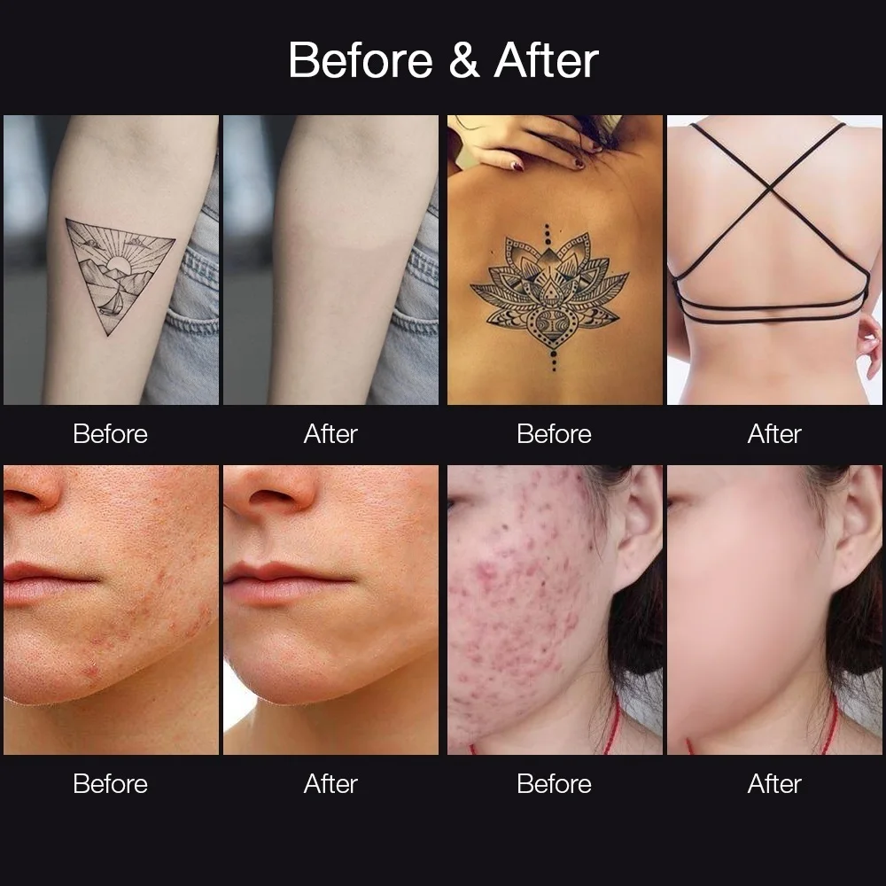 Профессиональный лазерный пикосекундных ручка синего и красного цветов для