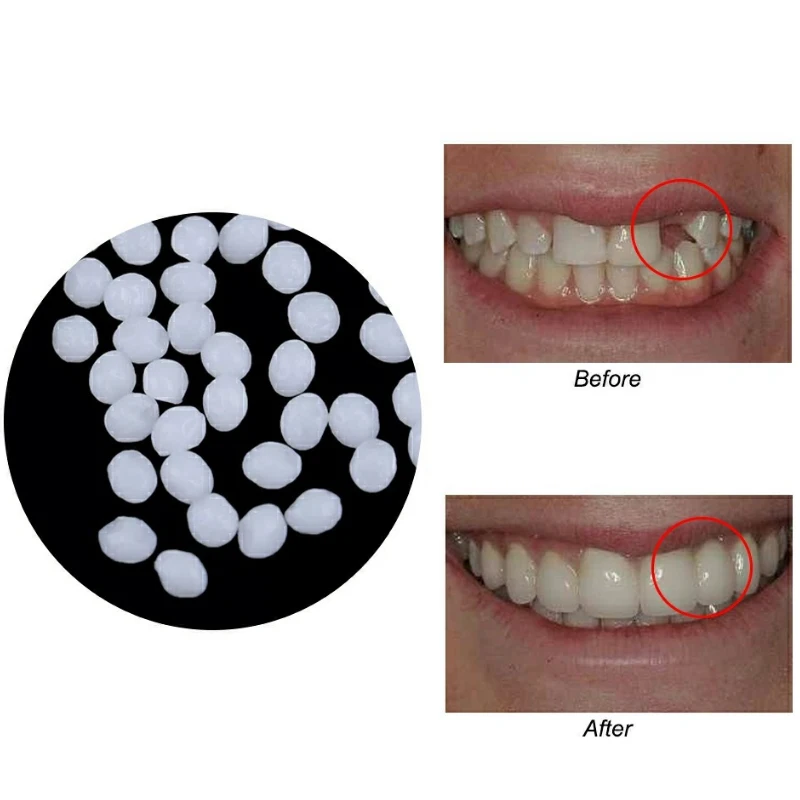Fake Teeth Repair Kit Thermal Molding Dental Material Beads Temporary False Tooth Replacement Tooth Filling