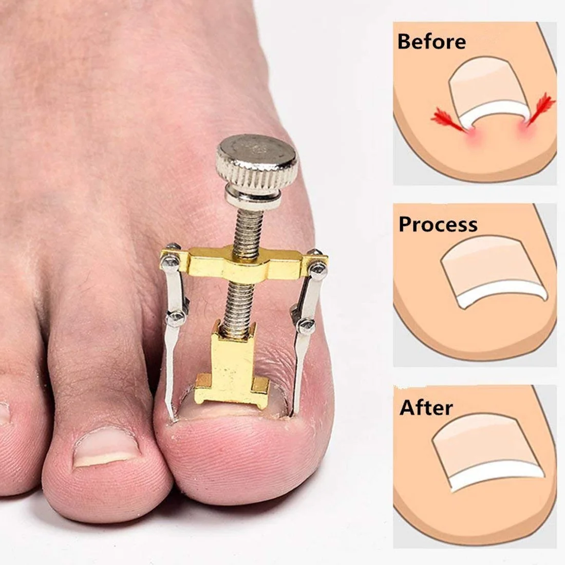 Инструмент для вросших ногтей педикюра Уход за ногтями на ногах инструменты файл