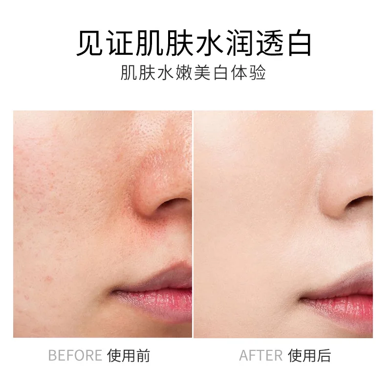 Осветляющая сыворотка для кожи осветляющая осветляющие пятна удаление акне