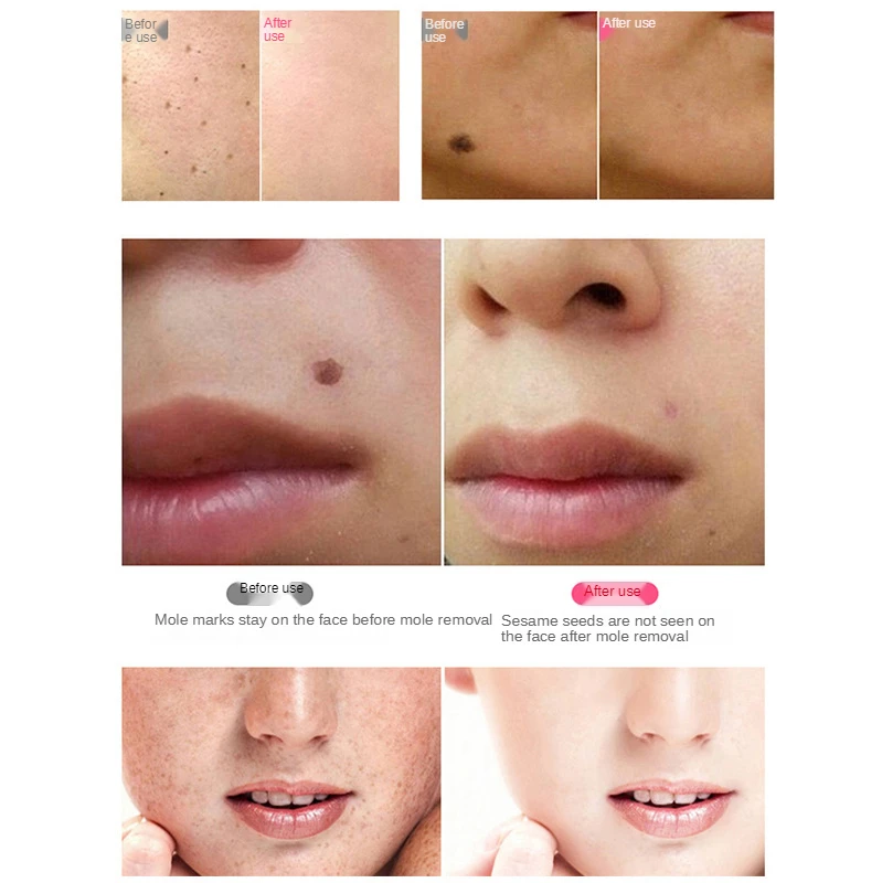 Бесплатная доставка ручка для удаления родинок лица белый крапинку пера