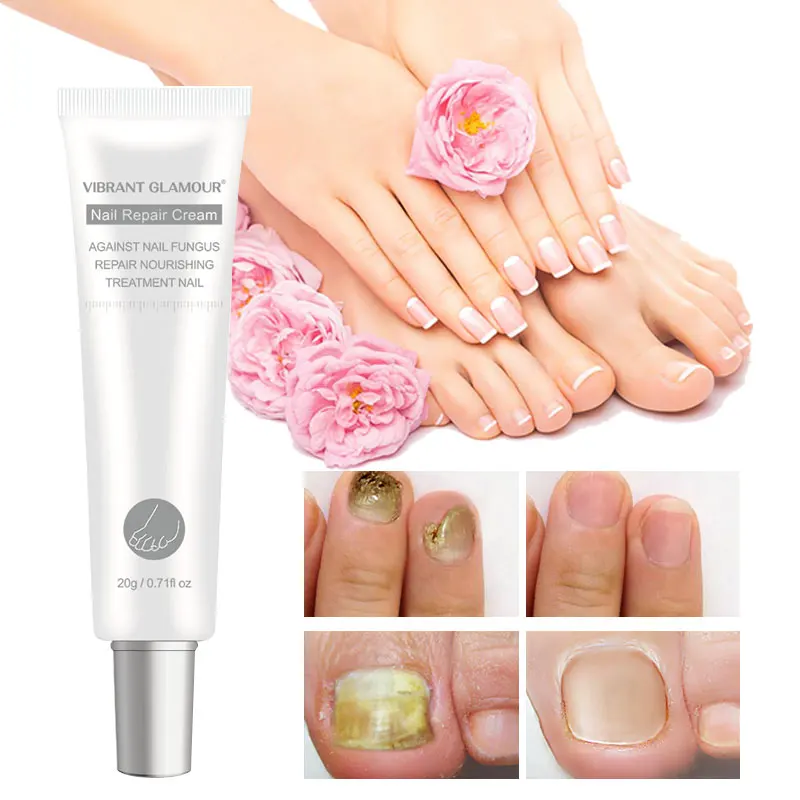 Крем для ремонта ногтей Лечение грибка Удаление онихомикоза анти грибок ног