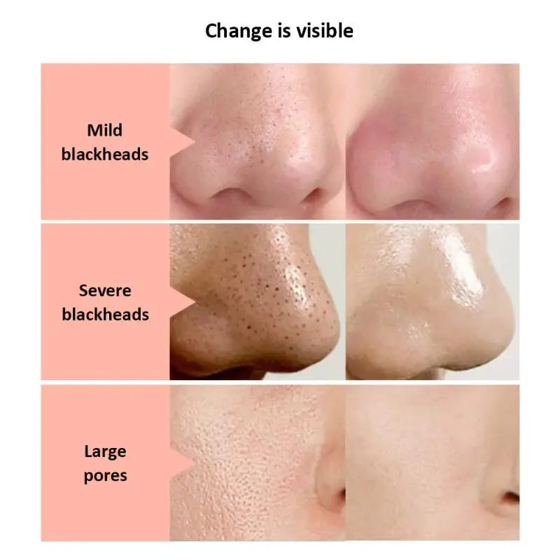 10/20 шт. удаление угрей маска назальная мембрана минеральной грязью носовые патч