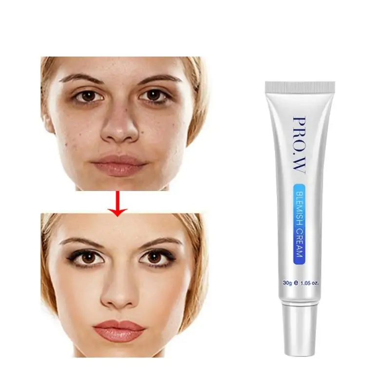 

Pro.W 30g Acne Treatment Blackhead Removal Anti Acne Cream Oil Control Shrink Pores Acne Scar Remove Face Care Dropship TSLM2
