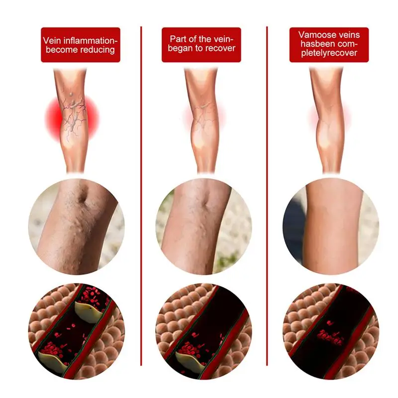 Набор для лечения варикозного расширения вен набор крем и ручка сисветильник |