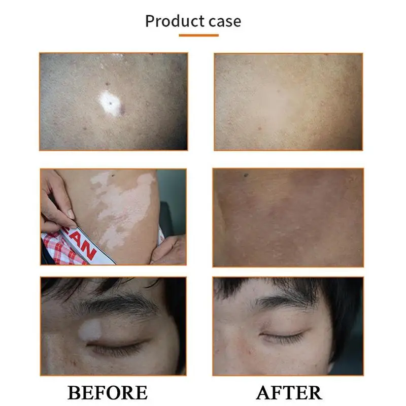 

Chinese Medical White Spots Antibacterial Disease Cream Iment Vitiligo Melanins Pigment Leukoplakia Treatment Diseases Prom A9D8