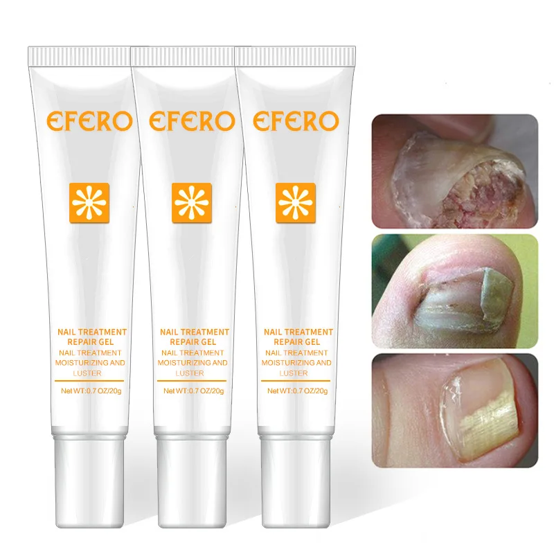 Nail Removal Exfoliating Scrub Whitening Nail Brightening Nail Repair Cream Thick Finger Nail Removal Liquid Nail-Soften Cream