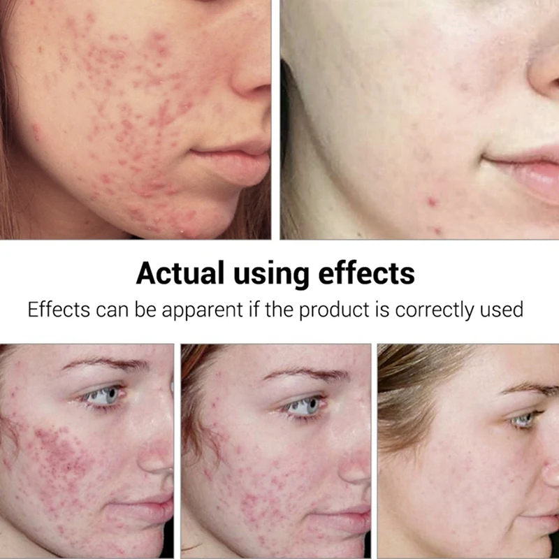 BREYLEE Acne Treatment Serum Facial Essence Anti Scar Removal Cream Face Skin Care Whitening Repair Pimple Remover For | Красота и