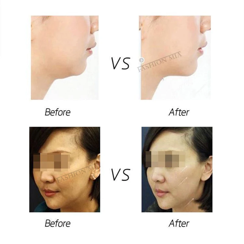 

Home Use Mini Hifu Ultrasonic RF Face Lifting Wrinkle Removal V-Shape Radar Line Carving Anti-Aging Tightening Beauty Machine