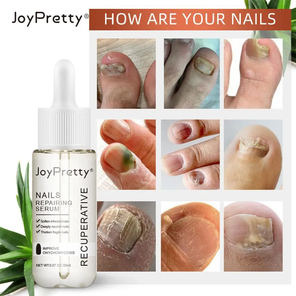 

20ml Nail Fungus Treatment Onychomycosis Removal Antifungal Nail Soft Repair Care Liquid Nail Finger Edge Peeling Oil G4L1