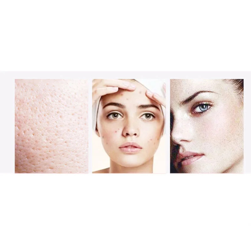 

Skin Scrubber Facial Cleaner Ion Acne Blackhead Remover Peeling Shovel Cleaner Facial Massager Face Lift Machine