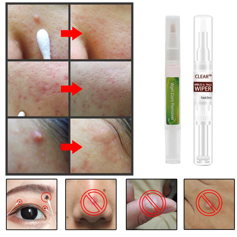 Новинка 3 мл лечение половых органов удаление папилломы бородавок жидкость с