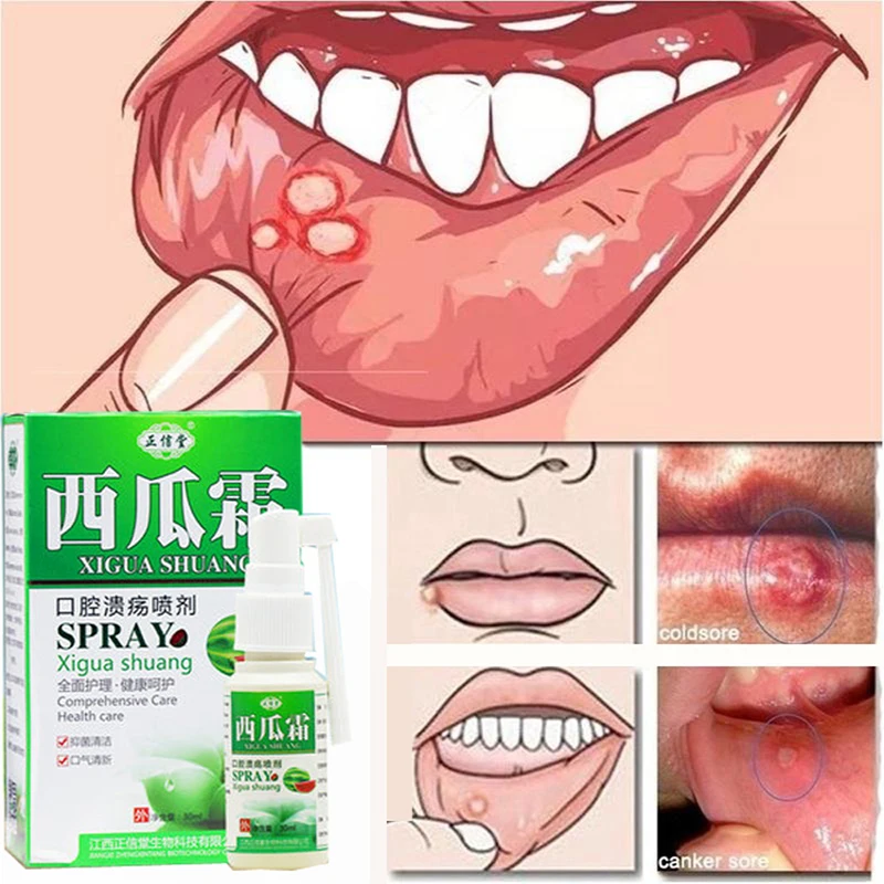 

Natural herbal oral spray oral cleansing freshener antibacterial ulcer toothache treatment relief pain oral ulcer spray 30ml