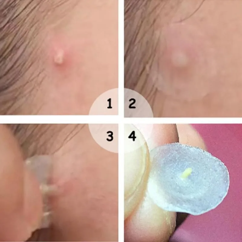 108 шт. накладки на прыщи невидимые наклейки лечение прыщей мастер удаления