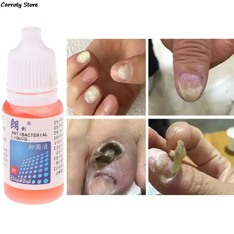 

10 мл Лак для ногтей аксессуары инфекции ремонт ручка онихомикоз противогрибковая носок Лечение грибка с пилка для ногтей Аксессуары для зд...