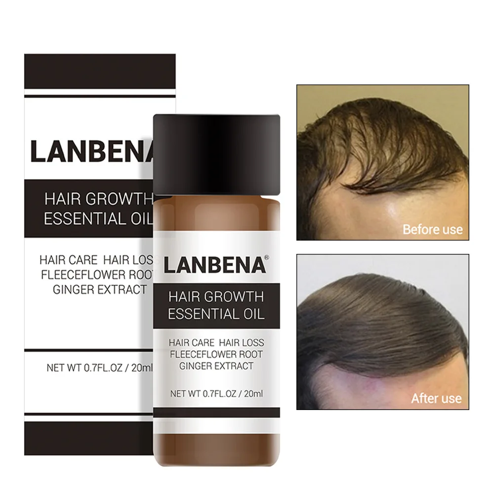 Эфирное масло имбиря для быстрого роста волос TCM эффективный экстракт против