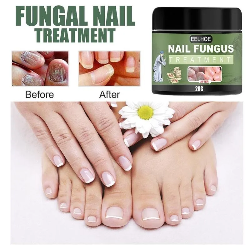 

Fungal Nail Treatment Serum Onychomycosis Paronychia Toe Infection Repair Fungus Essence Care Anti-Fungal Herbal Nail Foot U3L4