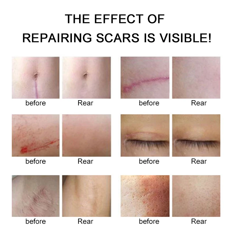 Removal Scar Cream Face Pimples Scar Stretch Marks Removal Acne Treatment Whitening Moisturizing Cream Skin Care TSLM1