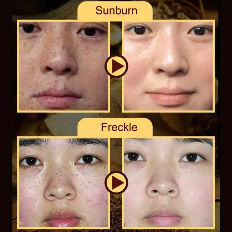 50 г крем для отбеливания веснушек удаления мелазмы акне пигмент меланин темных