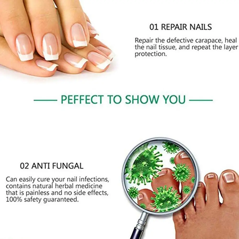 Противогрибковый набор для домашнего лечения ручка Ногтей онихомикоз пароникья