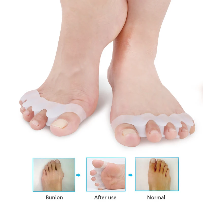 Ортопедический комплект для коррекции большого пальца стопы корректор