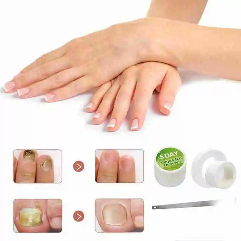 Китайская медицина травы брикет Лечение грибка удаление ногтей