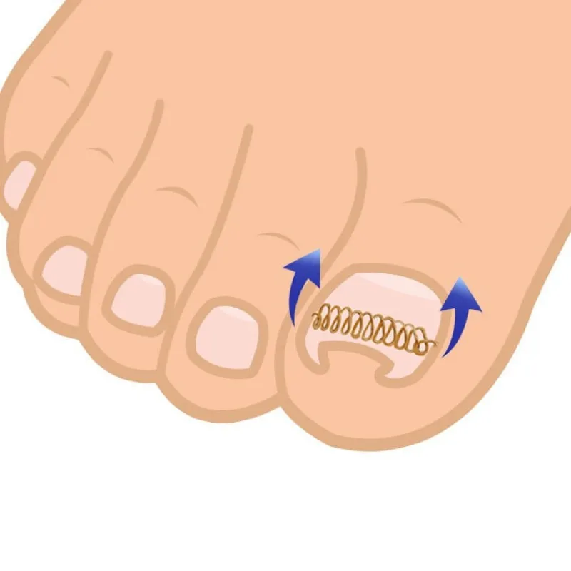 Лак для ногтей вросшие ногти леска коррекции восстановления патчи ухода