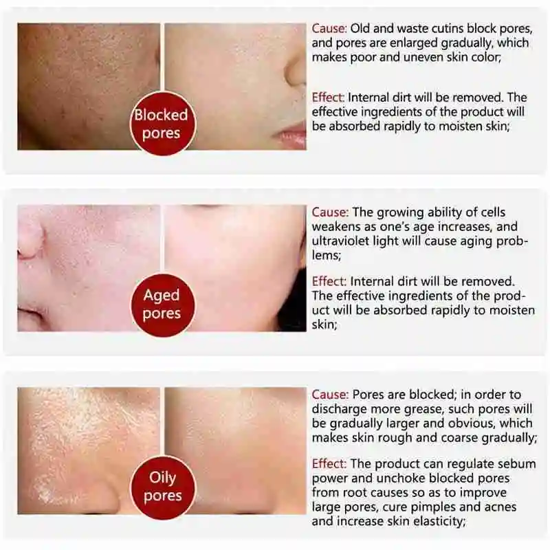 

Lambina Pore Shrinking Liquid Removes Blackheads And Whiteheads Acne Women And Men Deep Cleansing