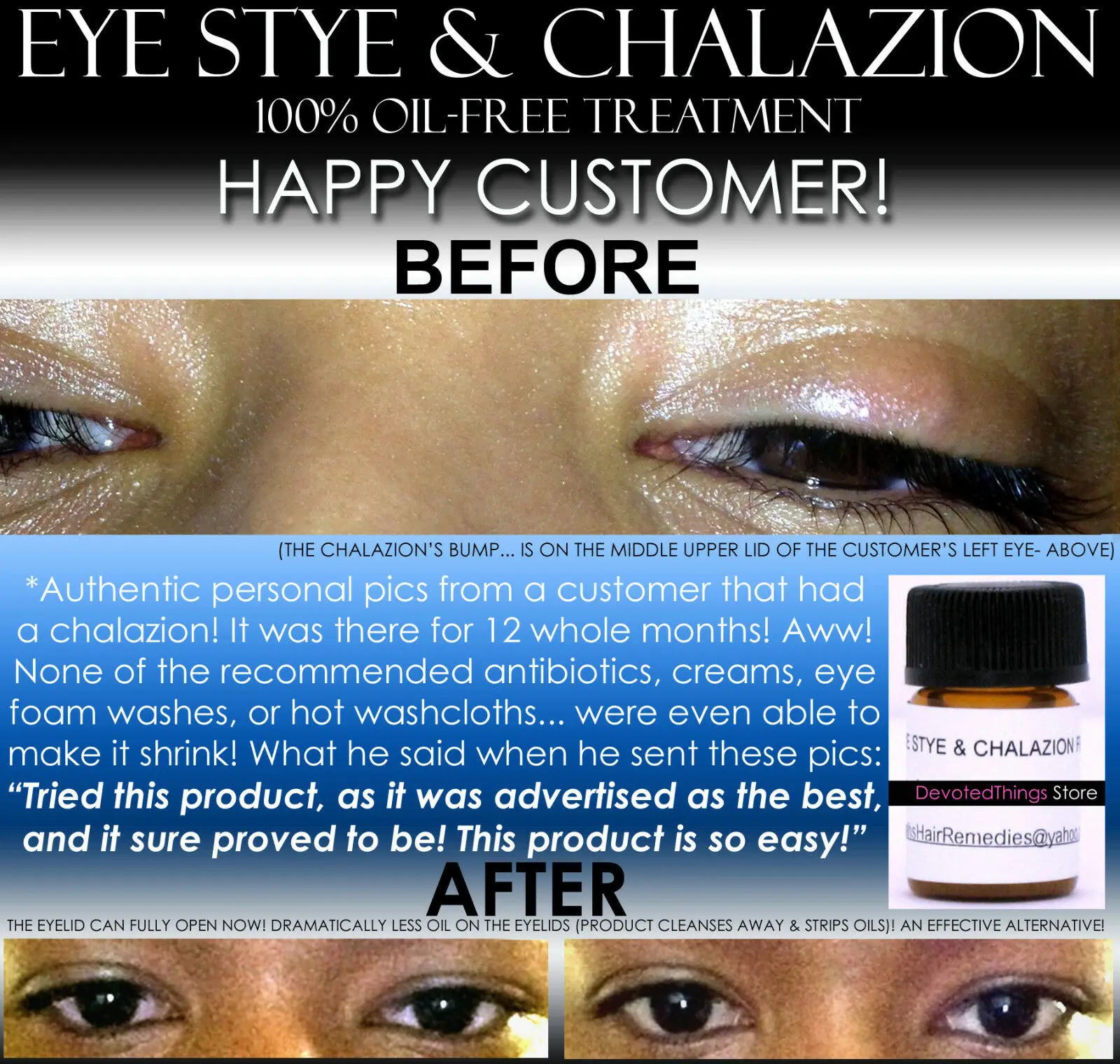 Home Eye Stye Treatment Chalazion Treatment Eyelid Infection Remedy