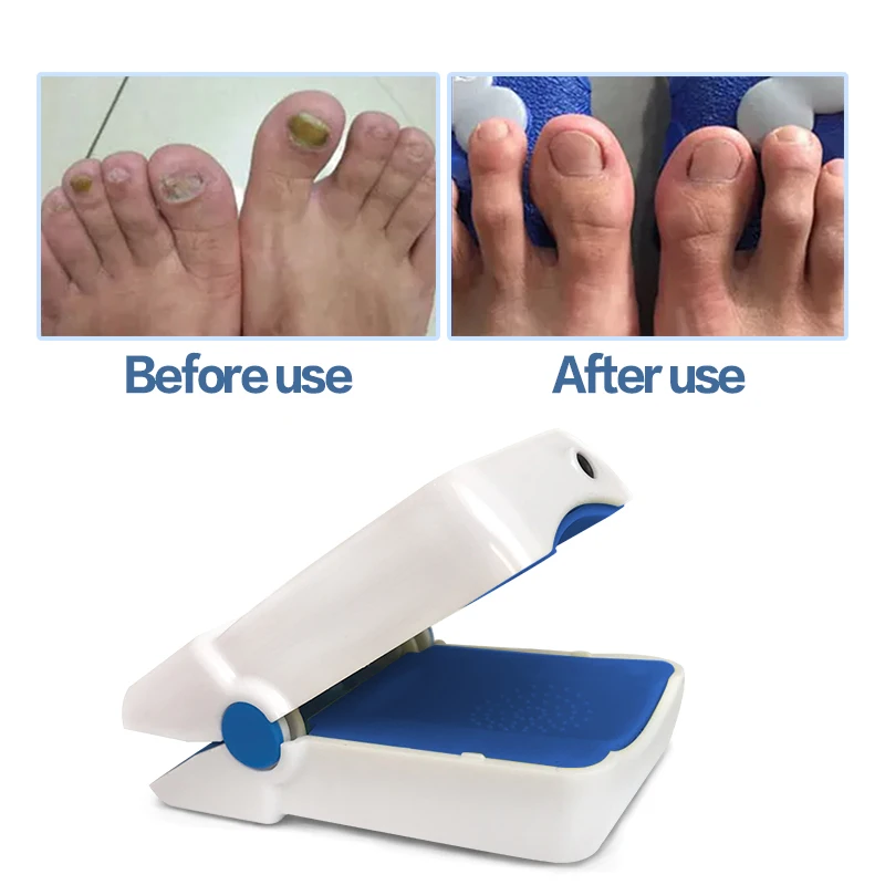 Home use laser for nail fungus treatment Cure Fungus Onychomycosis Painless Therapy Treatment For Toes And Fingernails | Красота и