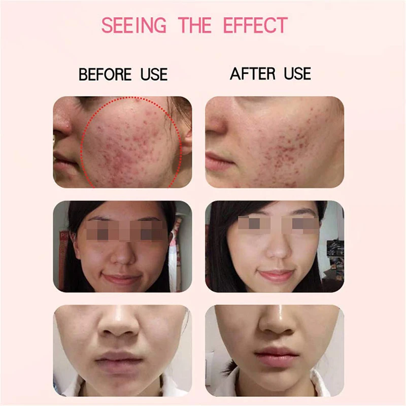 Плазменный повреждала нежную кожу ручка Лазер шрам для лечения прыщей крем лица