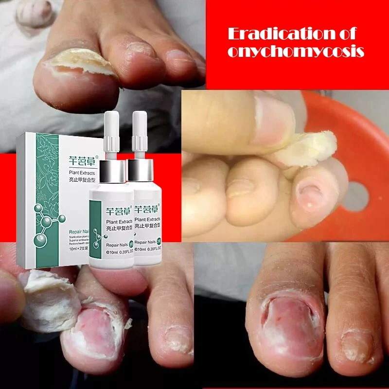 

Bactericidal Nail Treatment Natural Essence Oil Nail Liquid Repair Treatment Nail Toe Fungus Removal Moisturizing for Nail Foot