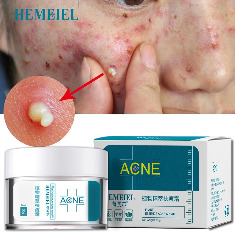 

Hemeiel Acne Cream Acne Treatment Anti Pimples Spot Acne Scars Blackhead Removal Cream Beauty Skin Face Care Whitening Creams