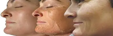 2ML 70% TCA Skin Peel Kit Removes Tags Age Spots White Stretch Marks Free Shipping | Красота и здоровье